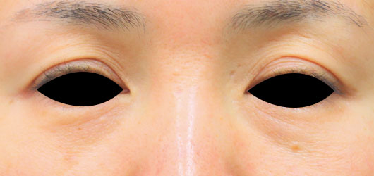 目のくぼみの症例写真（After）／50代 女性