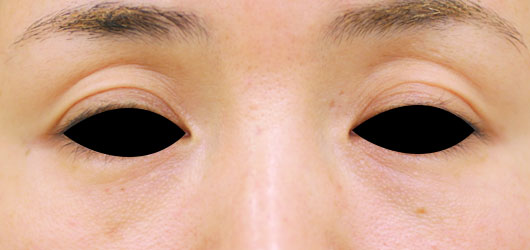 目のくぼみの症例写真（Before）／50代 女性