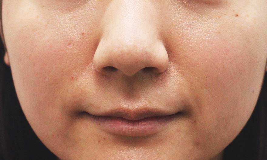 頬の症例写真（After）／20代 女性