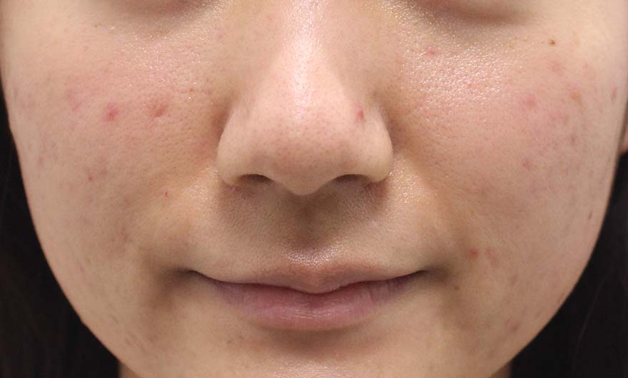 頬の症例写真（Before）／20代 女性