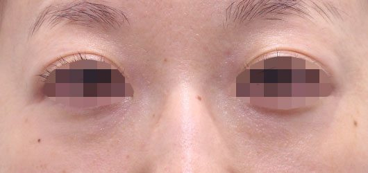 目の周りの症例写真（After）／30代 女性