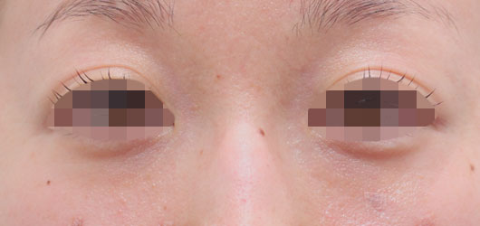 目の周りの症例写真（Before）／30代 女性