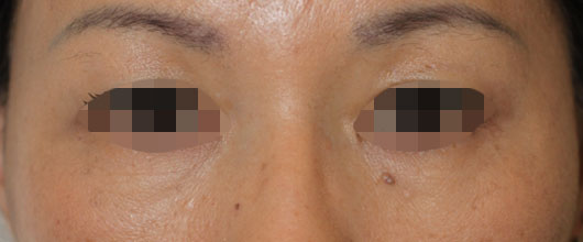 目の周りの症例写真（After）／50代 女性