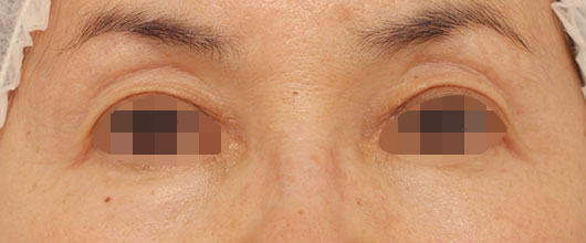 目の周りの症例写真（After）／60代 女性