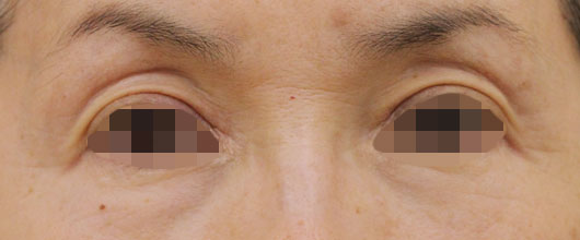 目の周りの症例写真（Before）／60代 女性