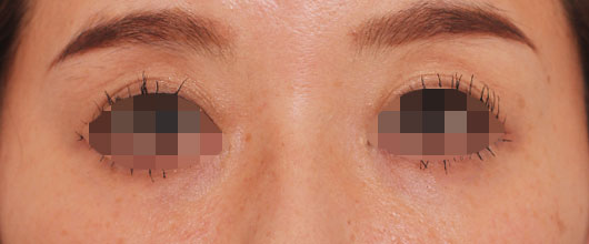 目の周りの症例写真（After）／40代 女性