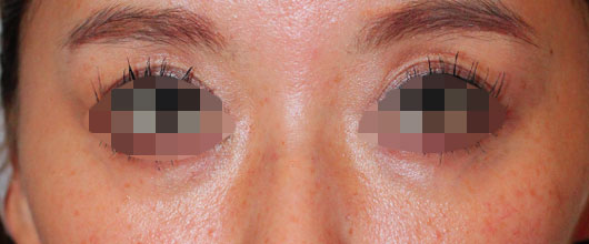 目の周りの症例写真（Before）／40代 女性