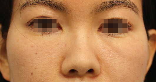 目の周りの症例写真（After）／30代 女性
