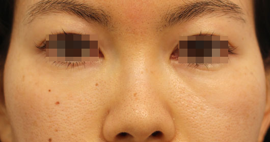 目の周りの症例写真（Before）／30代 女性