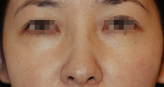 目の周りの症例写真（After）／40代 女性