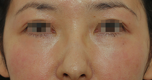 目の周りの症例写真（Before）／40代 女性