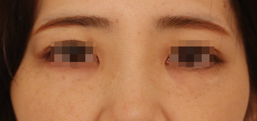 目の周りの症例写真（After）／30代 女性
