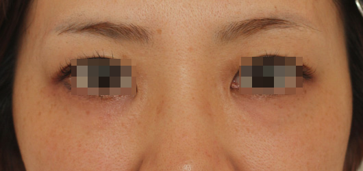 目の周りの症例写真（Before）／30代 女性
