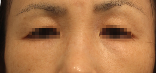 目の周りの症例写真（After）／50代 女性