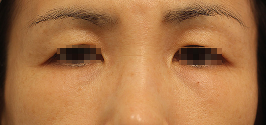 目の周りの症例写真（Before）／50代 女性