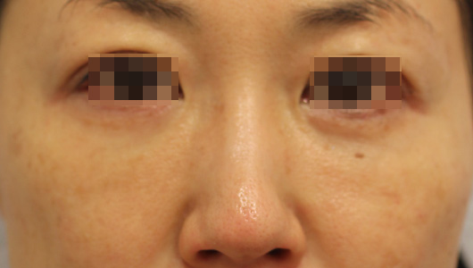 目の周りの症例写真（After）／40代 女性