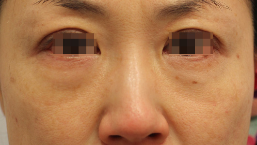 目の周りの症例写真（Before）／40代 女性