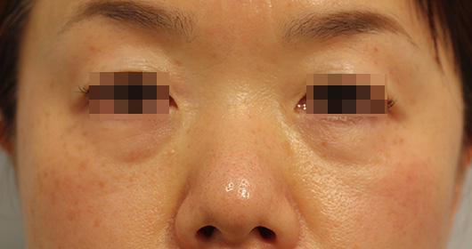 目の周りの症例写真（After）／40代 女性