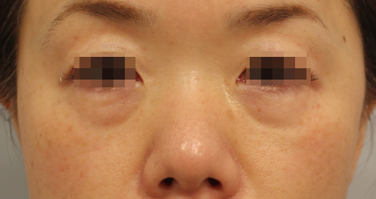目の周りの症例写真（Before）／40代 女性