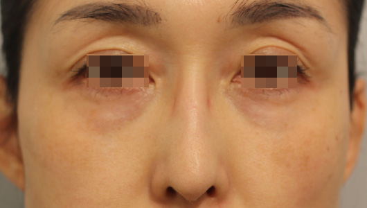目の周りの症例写真（After）／40代 女性