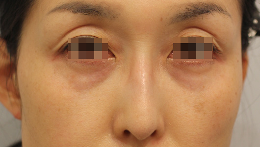 目の周りの症例写真（Before）／40代 女性
