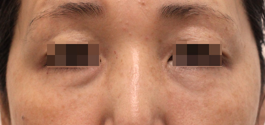 目の周りの症例写真（After）／50代 女性