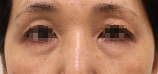 目の周りの症例写真（Before）／50代 女性
