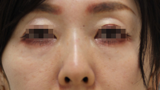 目の周りの症例写真（After）／40代 女性