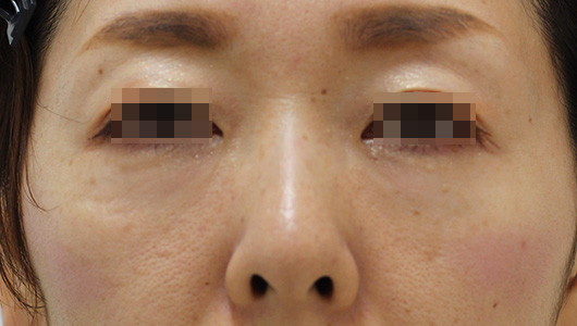 目の周りの症例写真（Before）／40代 女性