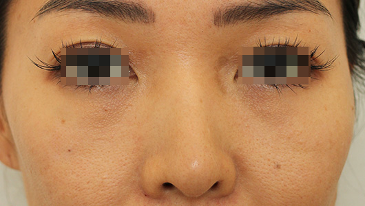 目の周りの症例写真（After）／30代 女性