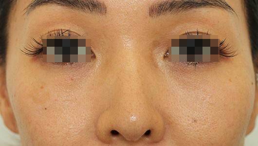 目の周りの症例写真（Before）／30代 女性