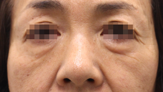 目の周りの症例写真（After）／50代 女性