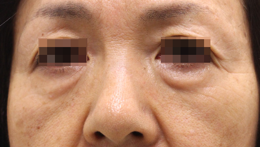 目の周りの症例写真（Before）／50代 女性