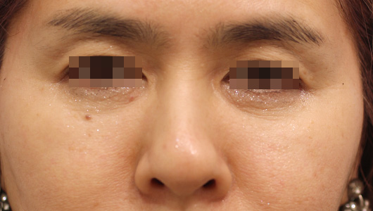 目の周り,目の下のクマの症例写真（After）／50代 女性
