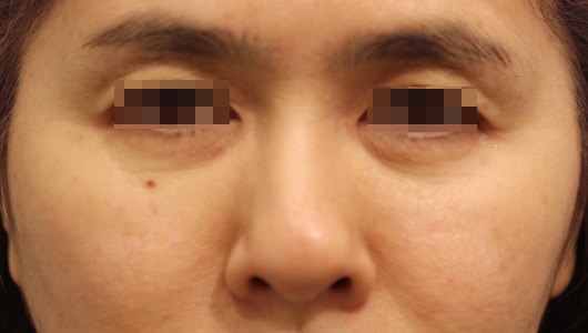 目の周り,目の下のクマの症例写真（Before）／50代 女性