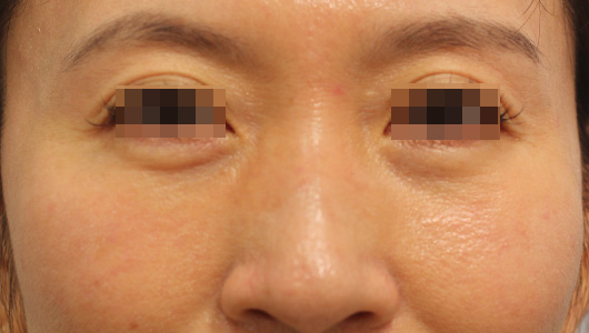 目の周り,目の下のクマの症例写真（After）／40代 女性