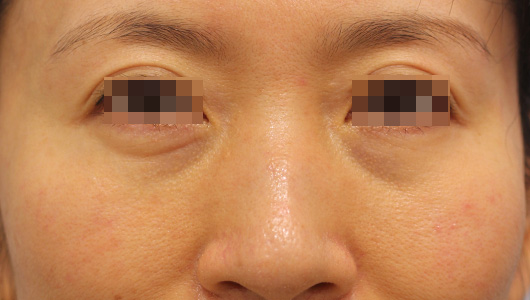 目の周り,目の下のクマの症例写真（Before）／40代 女性