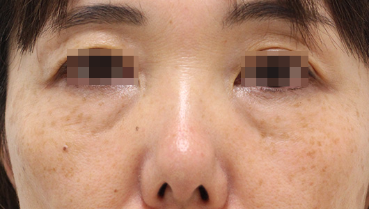 目の周りの症例写真（After）／50代 女性