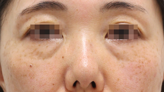 目の周りの症例写真（Before）／50代 女性