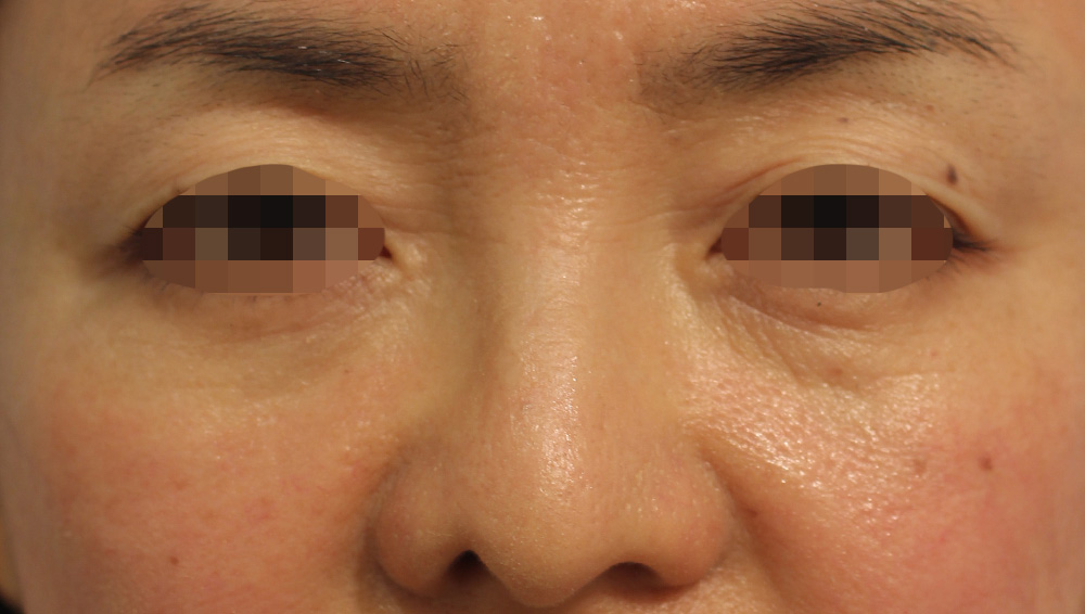 目の周りの症例写真（After）／50代 女性