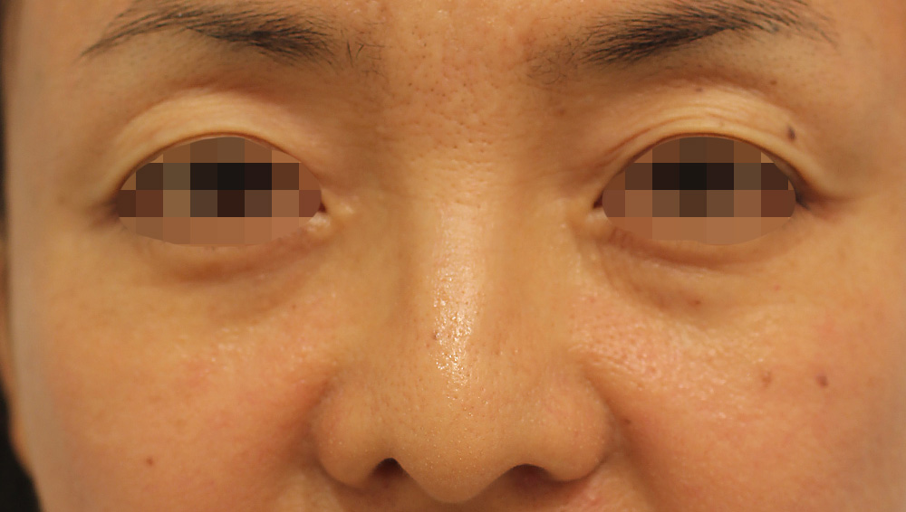 目の周りの症例写真（Before）／50代 女性
