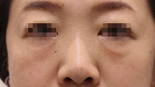 目の周りの症例写真（After）／50代 女性