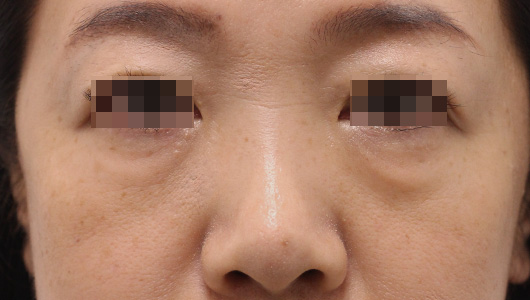 目の周りの症例写真（Before）／50代 女性