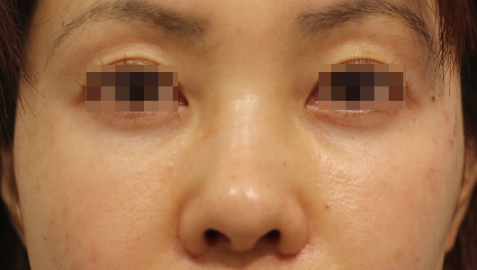 目の周りの症例写真（After）／30代 女性