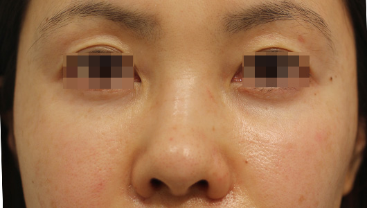目の周りの症例写真（Before）／30代 女性
