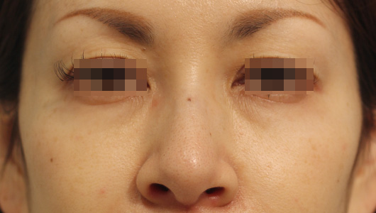 目の周りの症例写真（After）／40代 女性