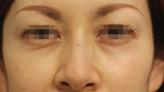 目の周りの症例写真（Before）／40代 女性
