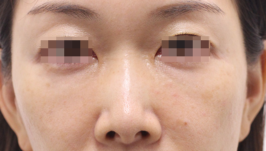 目の周りの症例写真（After）／40代 女性