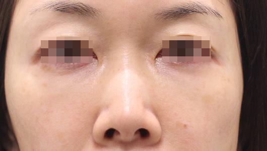 目の周りの症例写真（Before）／40代 女性