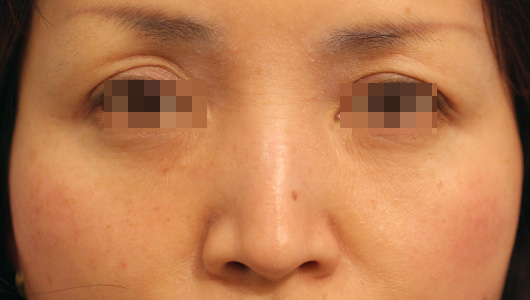 目の周りの症例写真（After）／40代 女性